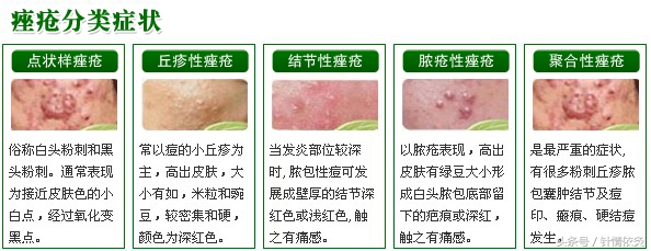 口鼻生疮针灸穴位,针灸治疗痈肿疮毒