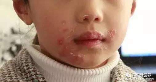 烂嘴角的饮食注意事项,烂嘴角怎么调理