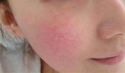 最近脸部红血丝越来越多什么原因,脸部红血丝的原因及治疗方法