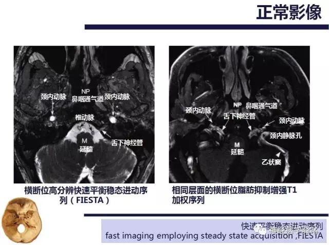 舌下神经和舌咽神经的解剖图,颊神经舌神经解剖图