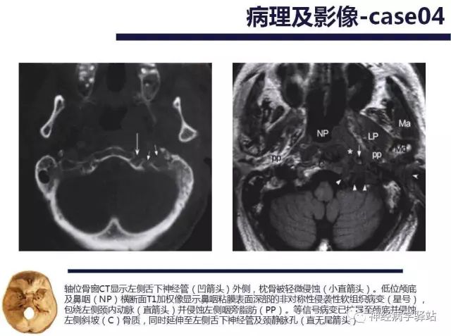 舌下神经和舌咽神经的解剖图,颊神经舌神经解剖图