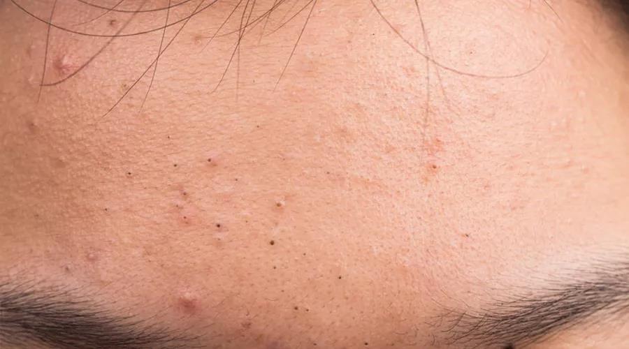 痘痘一直不好怎么办,痘痘一直反反复复怎么才能调理好