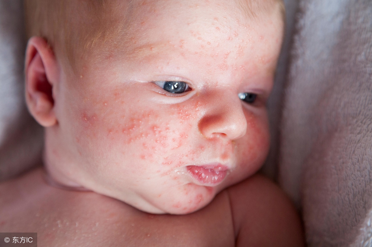 最近宝宝脸上起红疹子怎么办,宝宝脸上起红疹怎么办