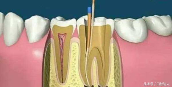 根管后戴个牙冠，是牙医在忽悠你吗？