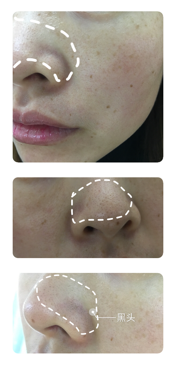 去黑头妙招分享一招搞定黑鼻头,12岁鼻头黑头怎么去除
