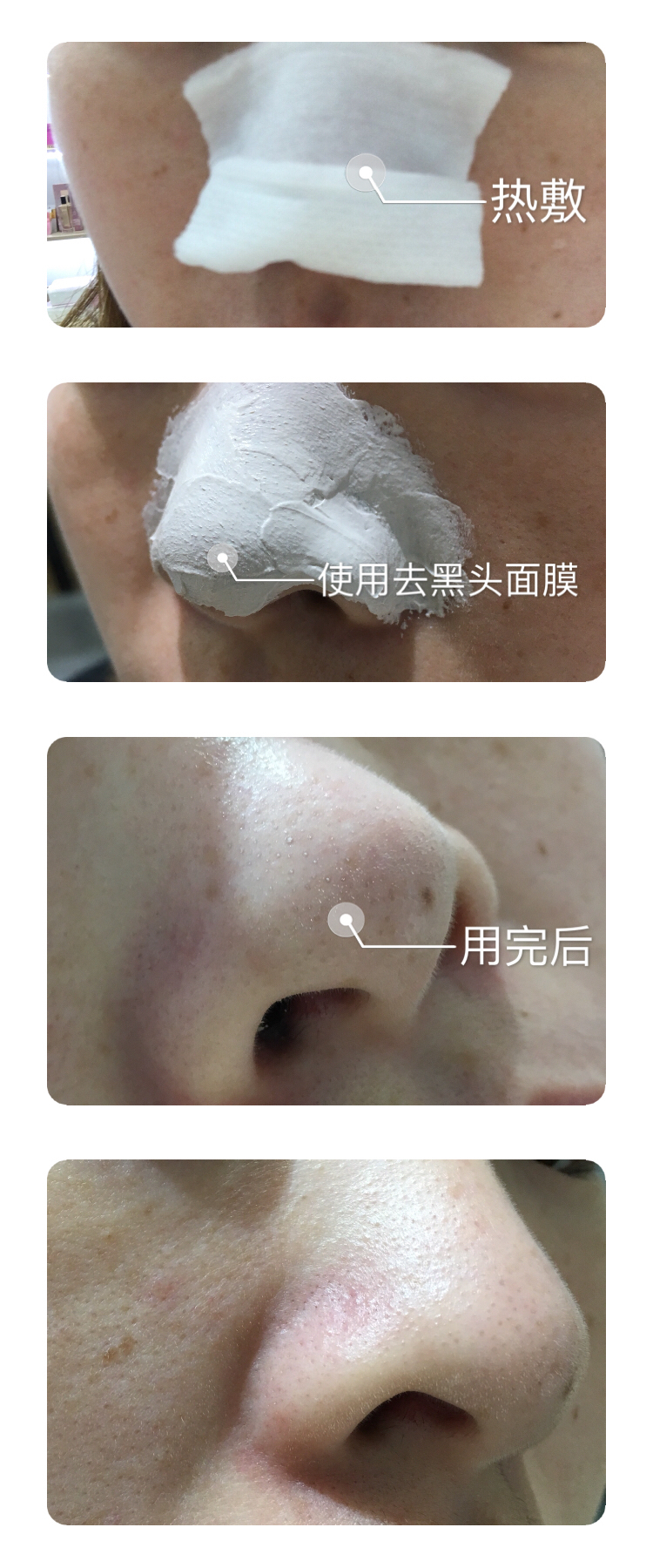 去黑头妙招分享一招搞定黑鼻头,12岁鼻头黑头怎么去除