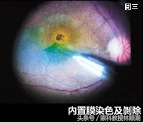 黄斑变性是致盲率非常高的眼病吗,近视性黄斑劈裂图片