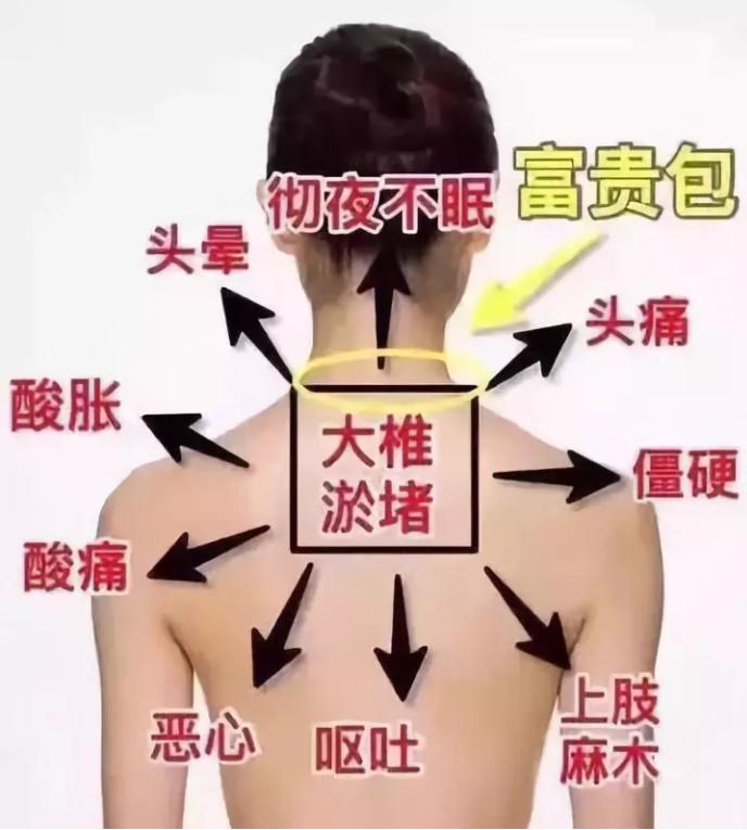 滑肩富贵包快速消除方法,厚背圆肩富贵包怎么消除