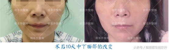 做眼袋提眉手术能变得年轻吗,哪种人不适合做提眉去眼袋