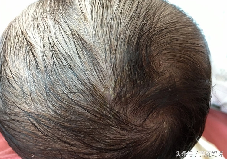 新生儿头上的乳痂要怎么处理,婴儿头上乳痂简单有效的清理方法