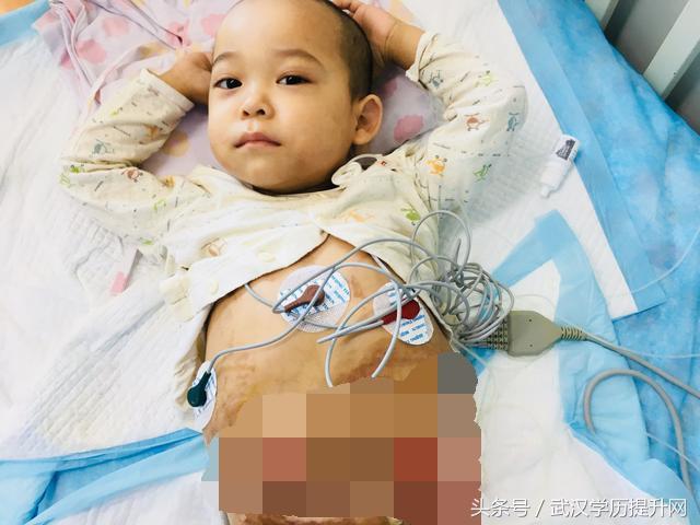 移植3次失败小男孩,男童两次移植均失败