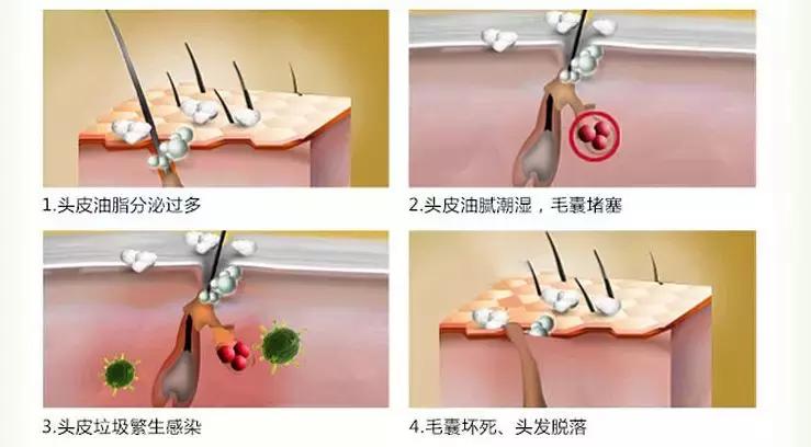 有许多明星脱发是怎样补救的,明星脱发都用什么方法