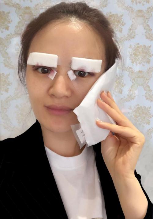 做完双眼皮的真实感受,双眼皮术后20天感觉眼睛变小了