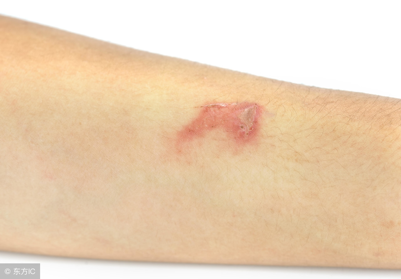 关于糖尿病的前兆,出现这四种症状是糖尿病