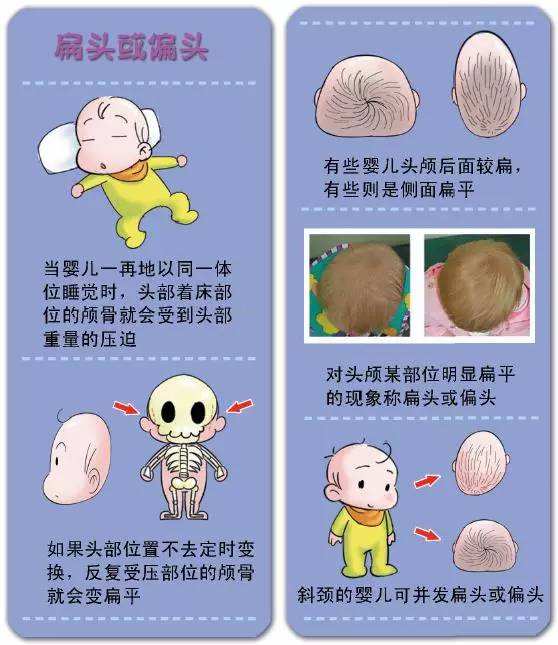 治疗小儿斜颈最好医院,斜颈分哪种类型
