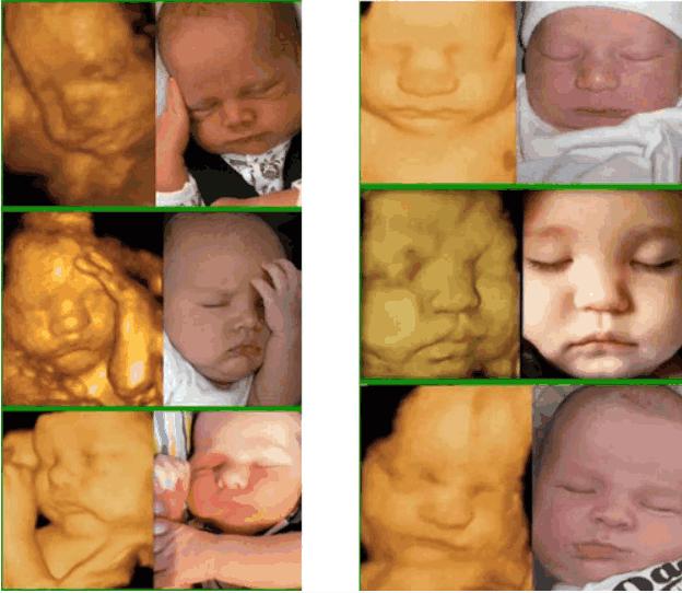 四维彩超宝宝不配合怎么办羊水少,四维产检宝宝不配合怎么办