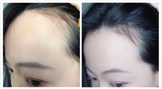 最新效果最好的防脱生发产品,全球公认最好用的10大防脱生发液