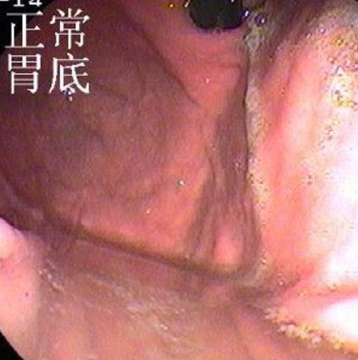 正常肠镜报告单图片大全,正常肠道的肠镜图片