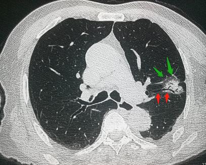 吸烟的肺癌患者放疗效果好吗,70岁肺癌放疗