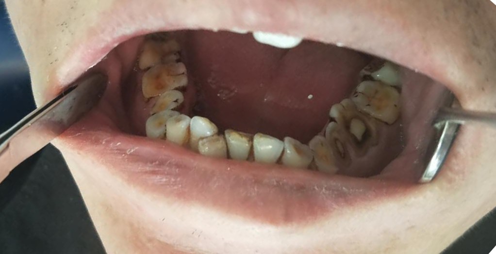 生活中常见的10大伤牙习惯，你中招了几个？