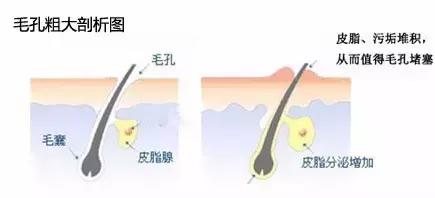 毛孔粗大到底该怎么办,鼻子毛孔粗大有洞怎么办