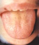 7种舌头暗示健康问题,各种病症舌头的颜色