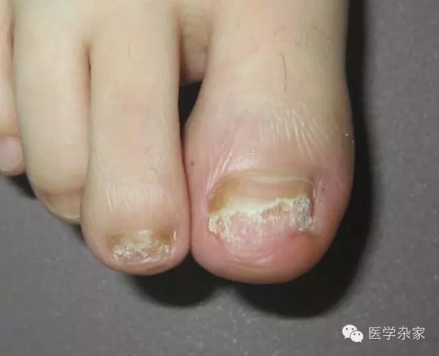 为什么脚气莫名其妙没有了,为什么脚气总是不能断根