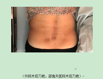 「直播来了」骨科医生给脊柱做了个翻修术错位腰椎归队了