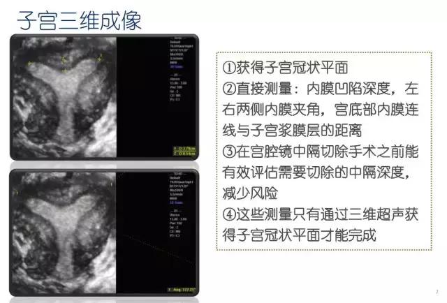 妇科超声波探头,福建省妇幼保健院输卵管超声造影
