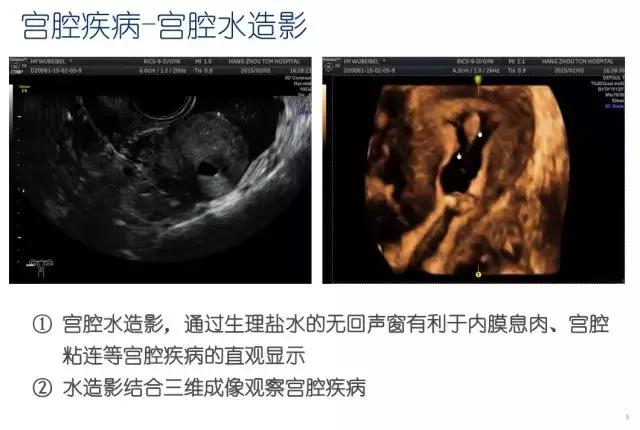 妇科盆腔彩超探头,妇科超声波探头