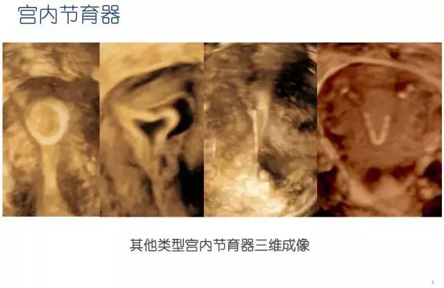 妇科超声波探头,福建省妇幼保健院输卵管超声造影