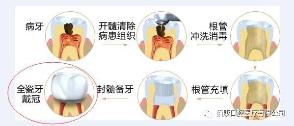 根管治疗的步骤图,根管治疗的步骤和重点