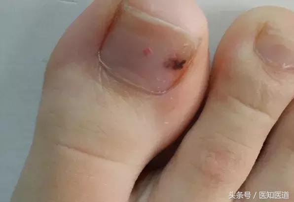 身上的痣会不会癌变一张图告诉你,身体上7种痣容易癌变