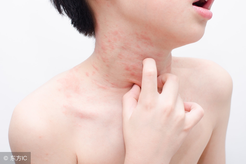 麻疹的处理,麻疹要怎么治才能除根