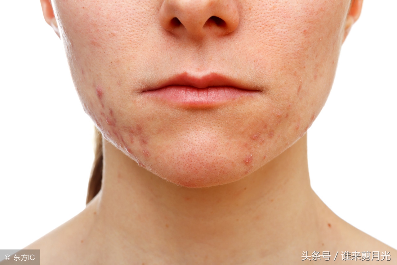 脸颊两边长痘痘是肝火旺引起的,脸颊两边长痘痘是身体哪里不好