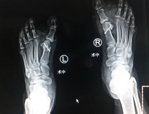 20岁脚趾外翻矫正,踇外翻的处理过程视频