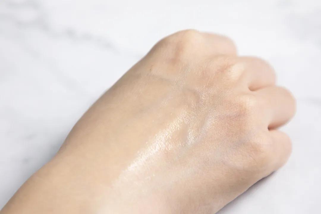 让无数姑娘无从下手的痘印，皮肤科医生有了解决新招