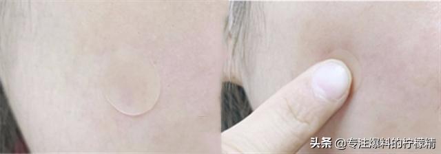 片仔癀的祛痘产品怎么样,片仔癀祛痘贴评价