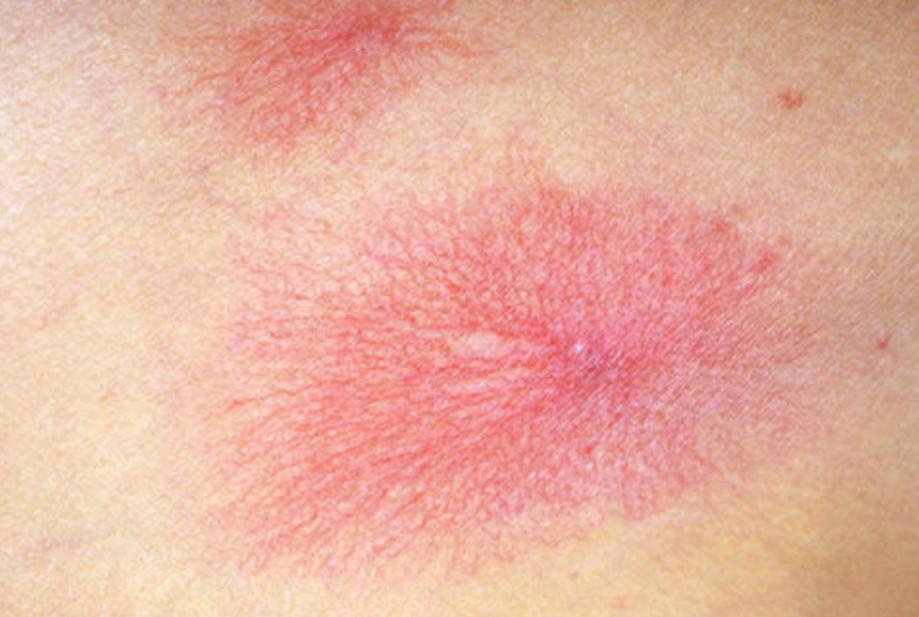 皮肤上长红痣要当心是肝病的征兆,身上长了几个细细的红痣是肝病吗