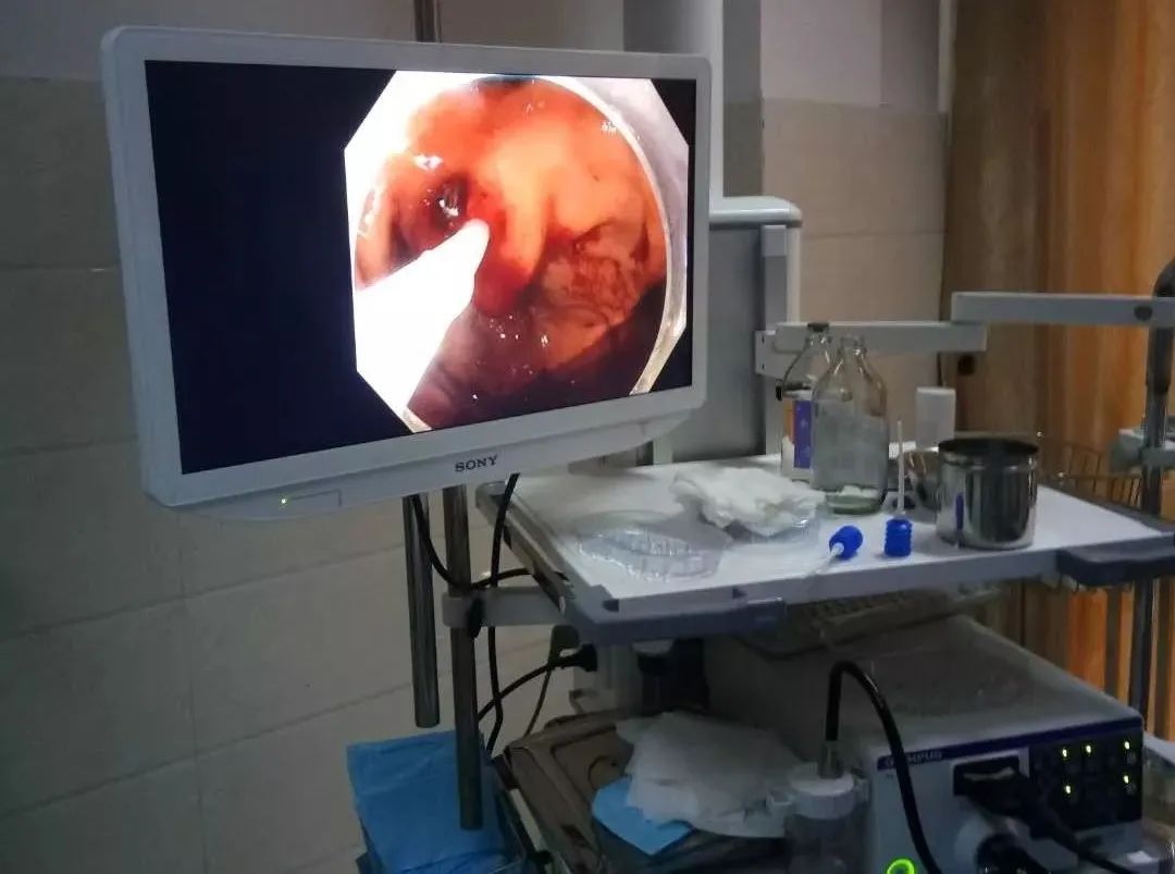 消化道出血的内镜治疗,消化道出血的内镜下治疗