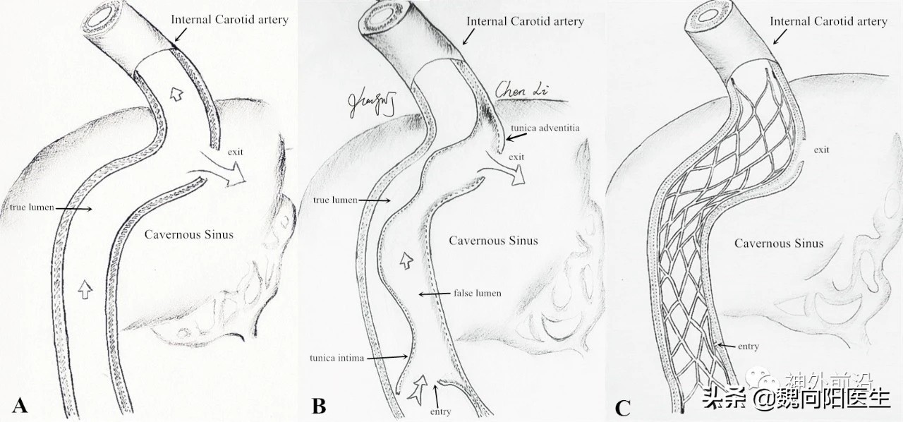 颈动脉闭塞血管夹层,颈动脉夹层是什么原因形成的