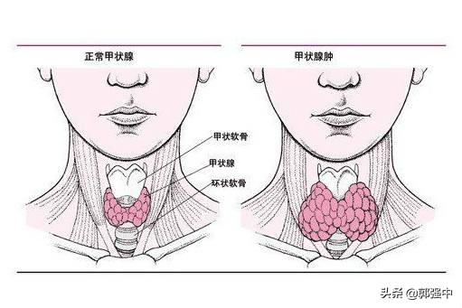 甲状腺肿大吃药没用，咋办？