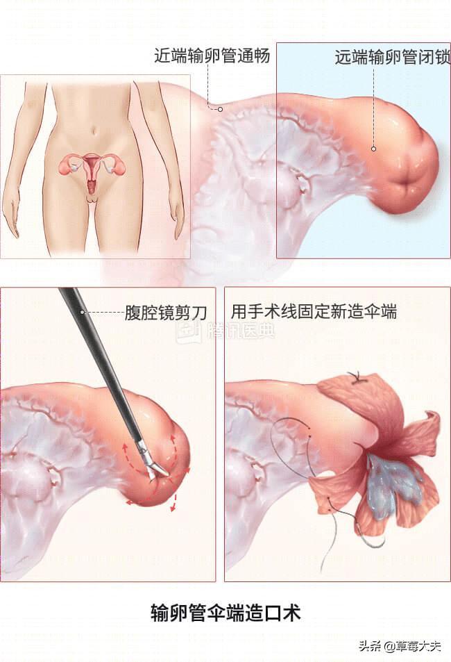 医生也成“催生婆”?不!是你输卵管出问题了......