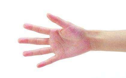 手脱皮是什么原因该怎么办,手脱皮是什么原因造成的怎么治疗