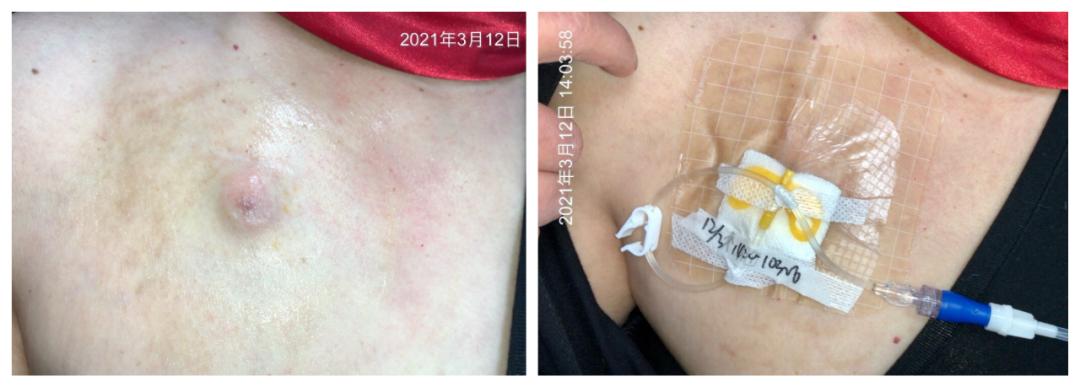 输液港的地方痒是怎么回事,输液港有点红肿是怎么回事