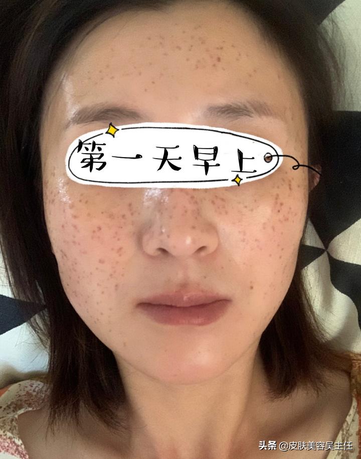 蜂巢皮秒英诺小棕瓶,脸上有斑的可以用英诺小棕瓶吗