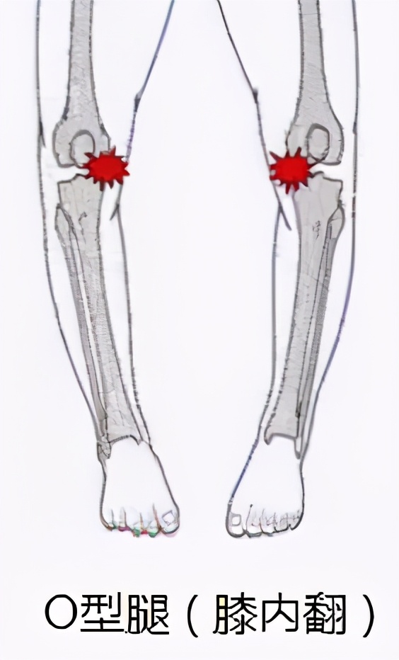 「病例精选」不用换关节，TCVO手术给您新“膝”望