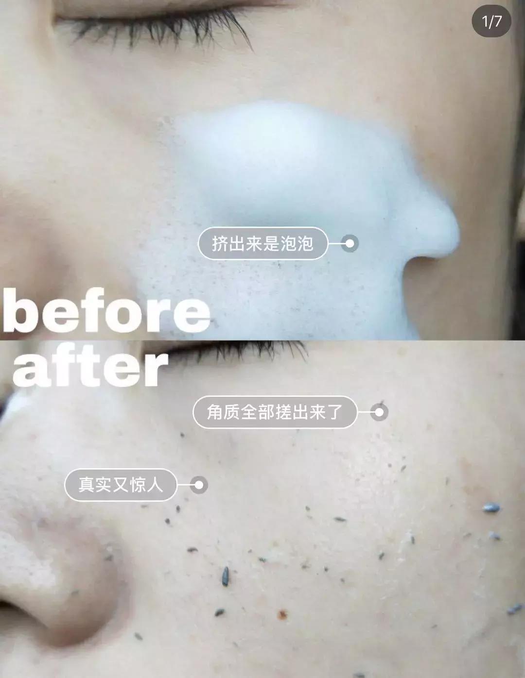 吸黑头神器去粉刺角质收缩毛孔,皮肤清洁收缩毛孔黑头角质