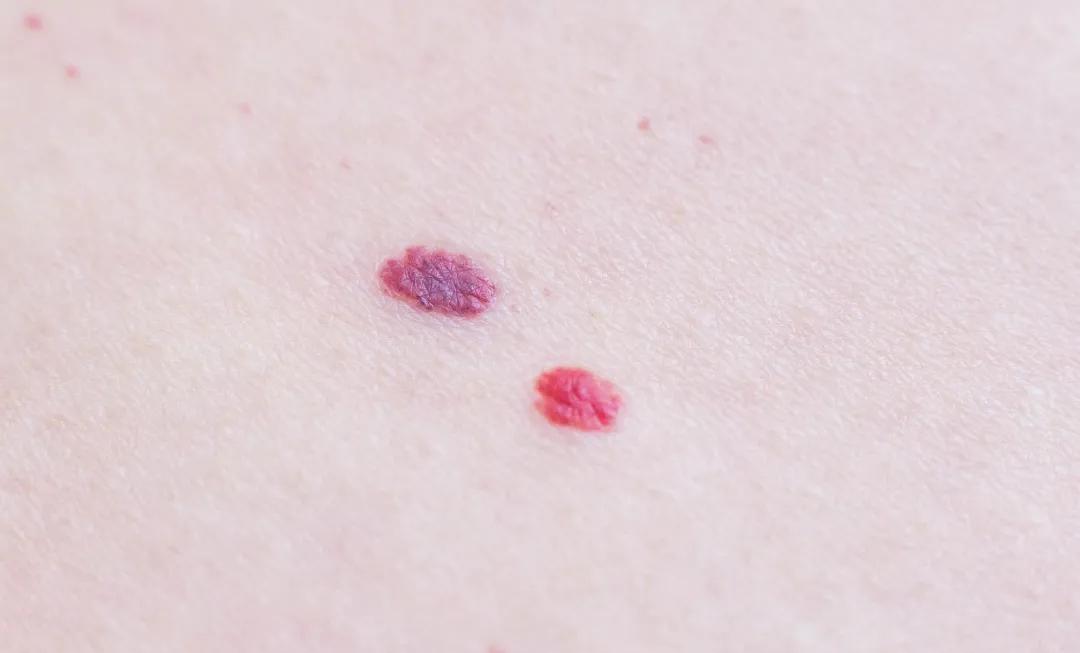 身上出现这种红点千万要注意,身上出现了许多小红点怎么治疗
