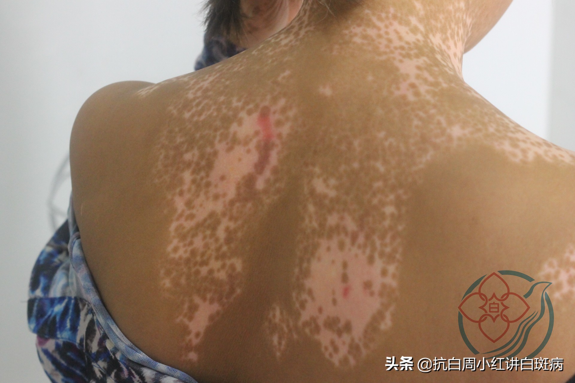 白癜风的白斑一般的症状是什么呢,白癜风的白斑一般的症状是什么